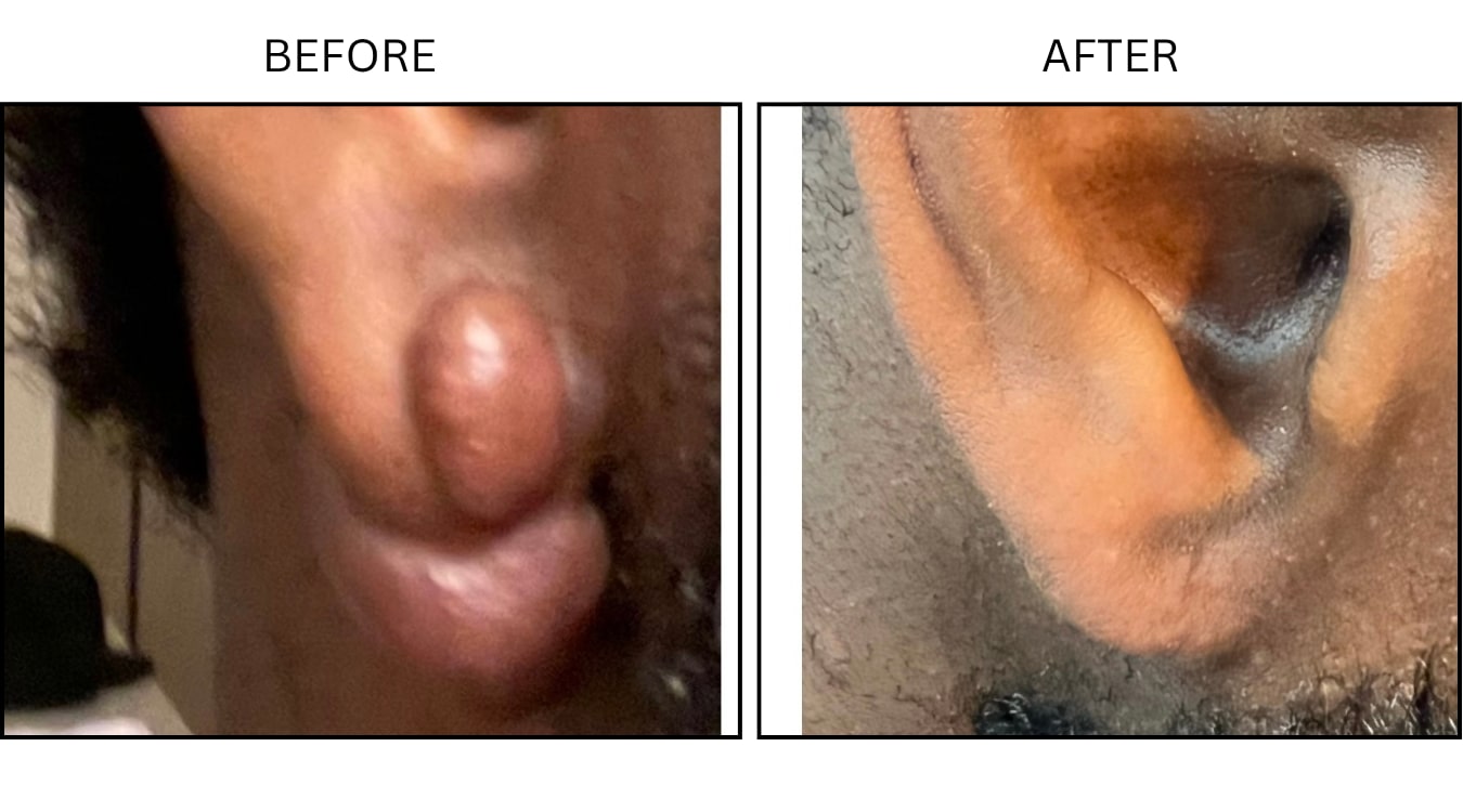 Keloids (Surgical (benign Destruction)), before and after photograph 11