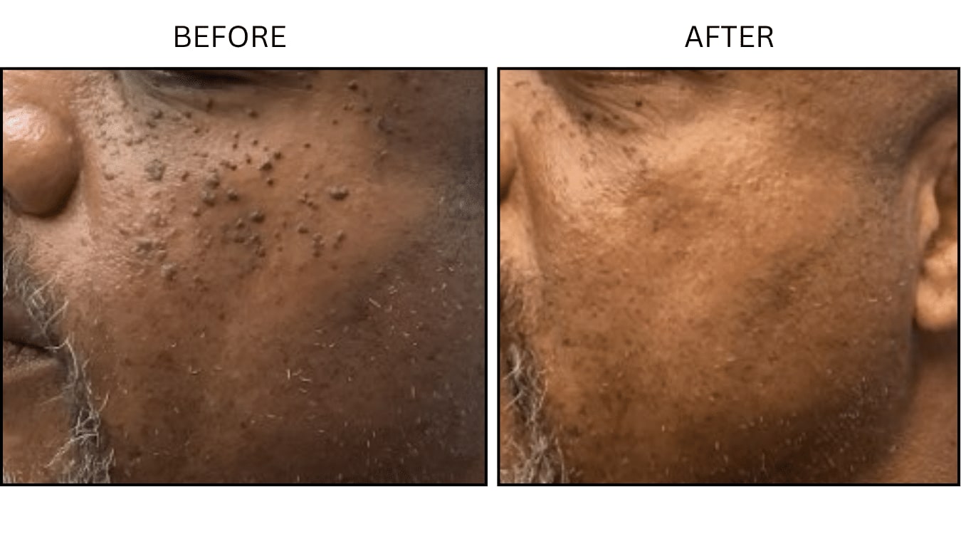 Keratoses (Medical), before and after photograph 2