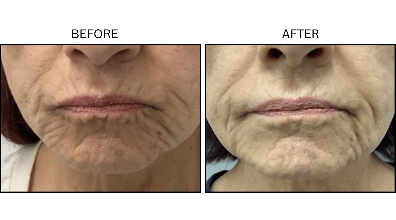 Lips (Neurotoxin Relaxers), before and after photograph 1