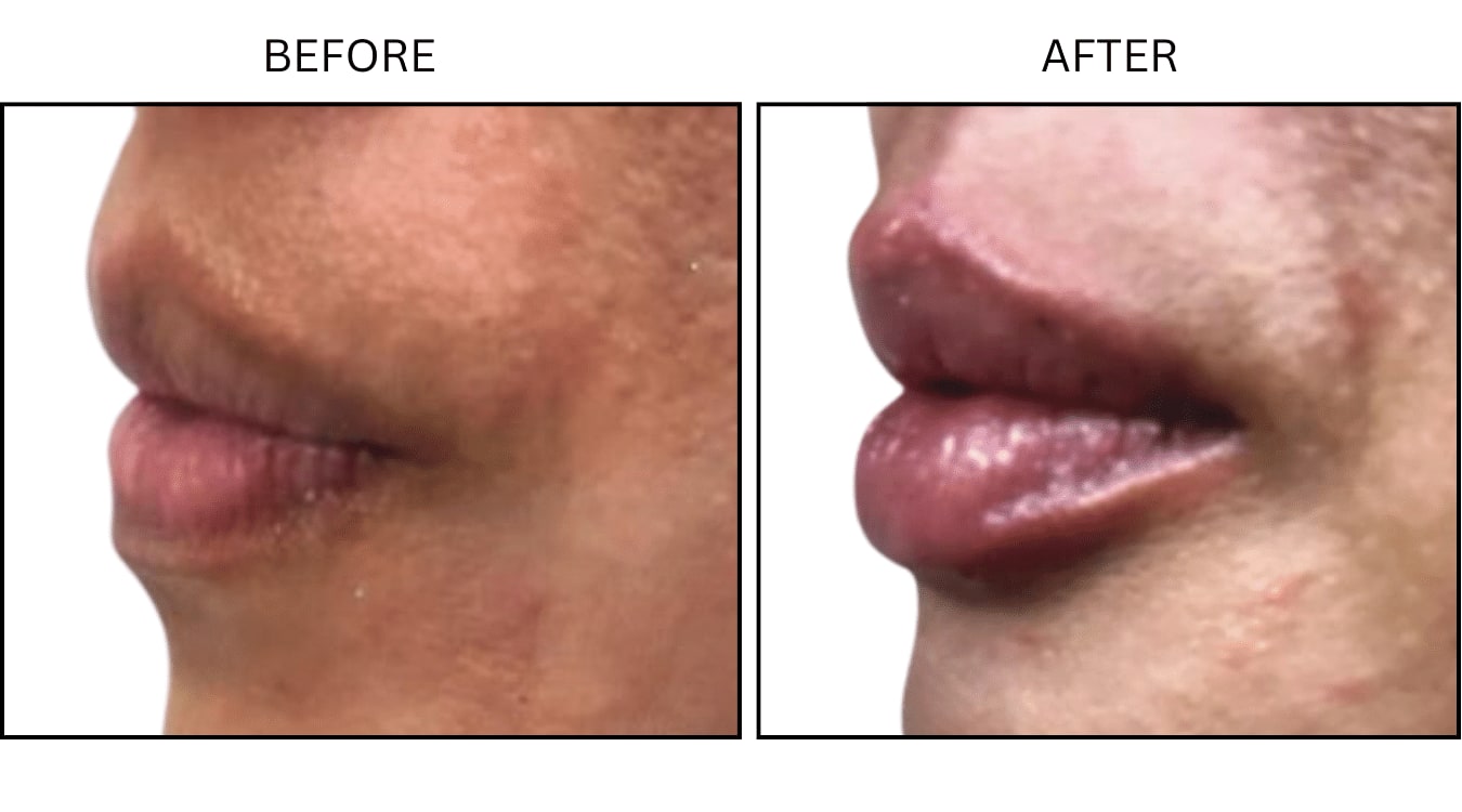 Lips (Fillers), before and after photograph 18