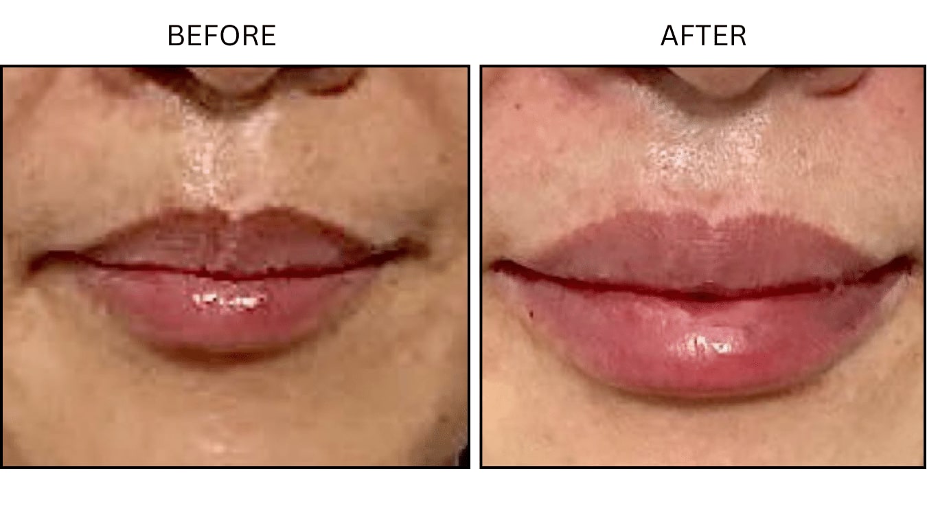 Lips (Fillers), before and after photograph 9