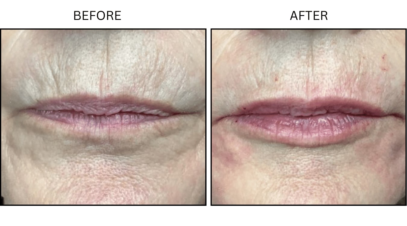Lips (Fillers), before and after photograph 11