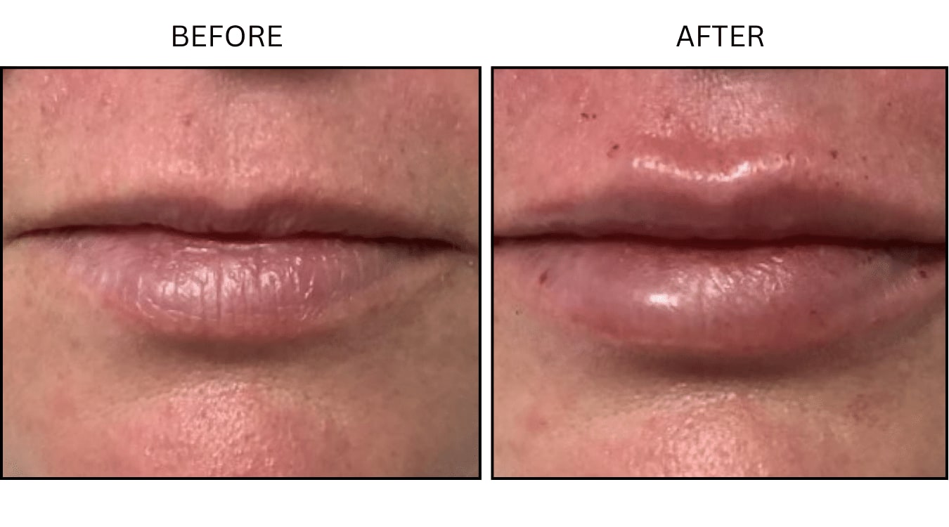 Lips (Fillers), before and after photograph 10