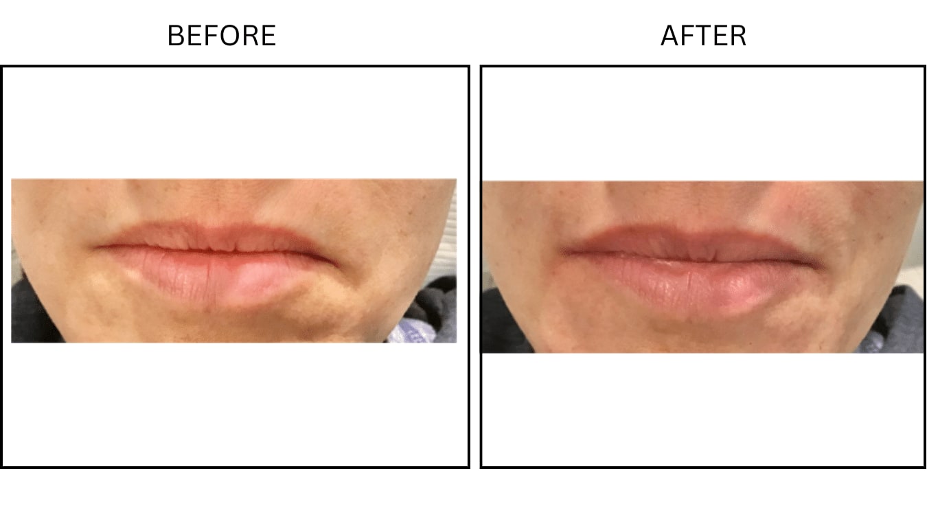 Lips (Fillers), before and after photograph 13