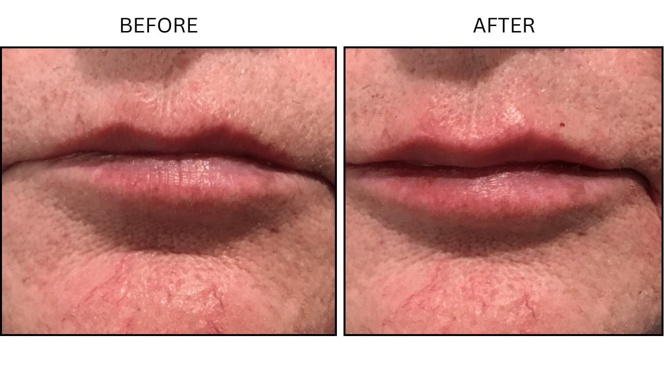 Lips (Fillers), before and after photograph 14