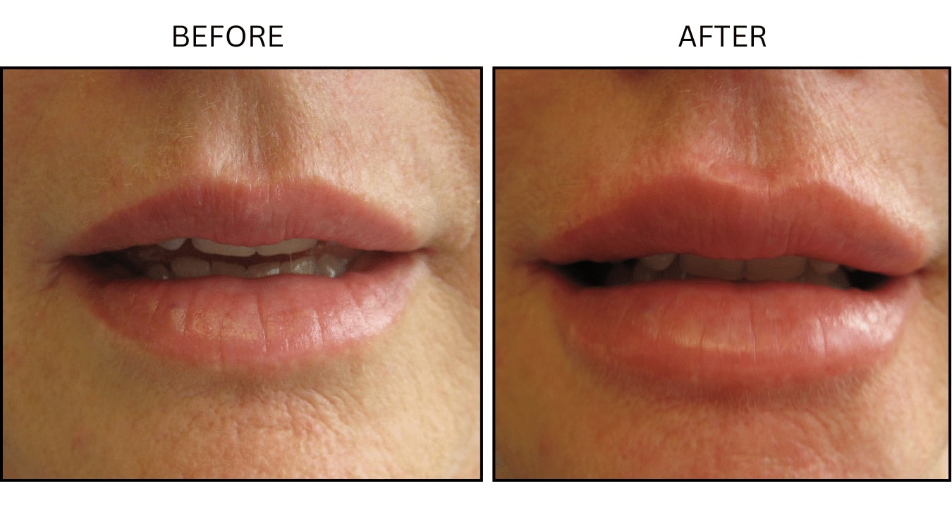 Lips (Fillers), before and after photograph 16