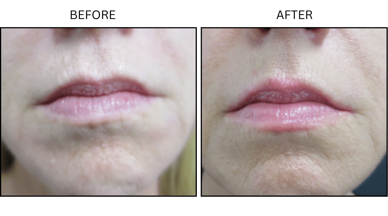 Lips (Fillers), before and after photograph 17