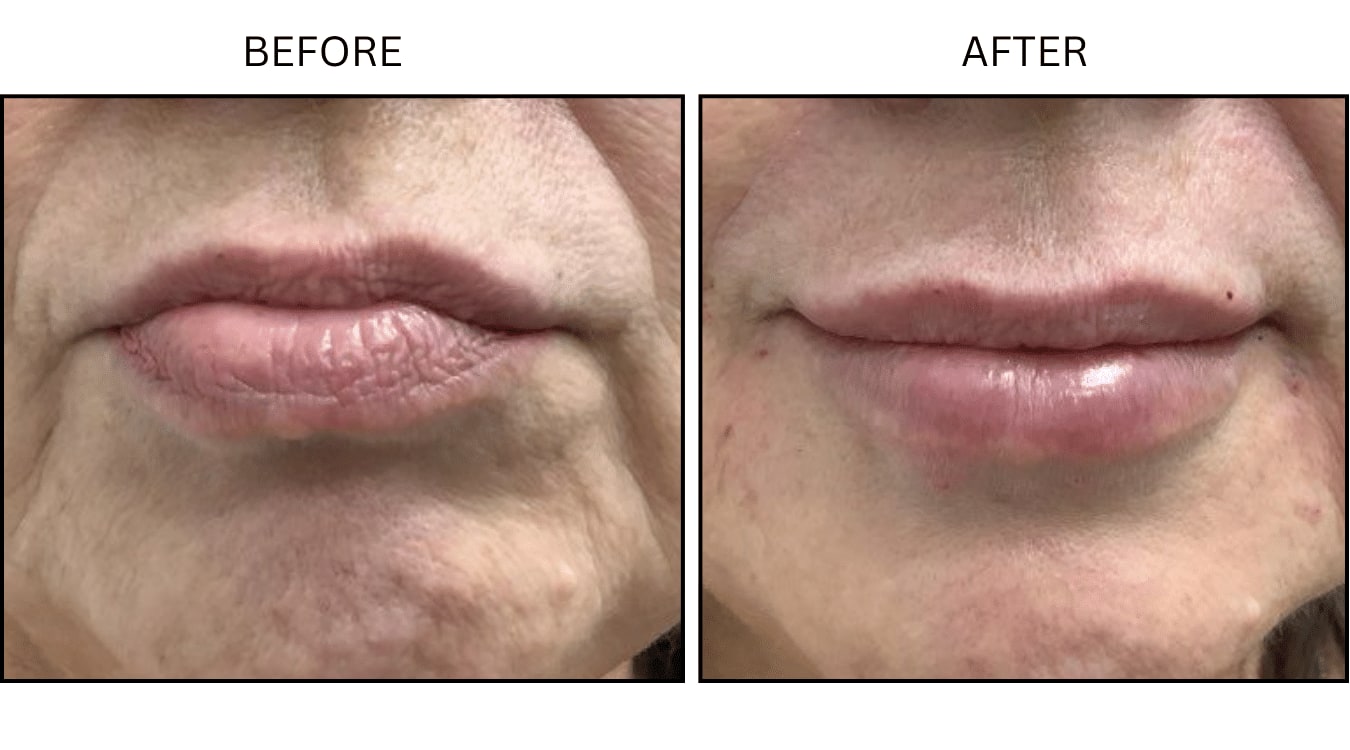 Lips (Fillers), before and after photograph 15