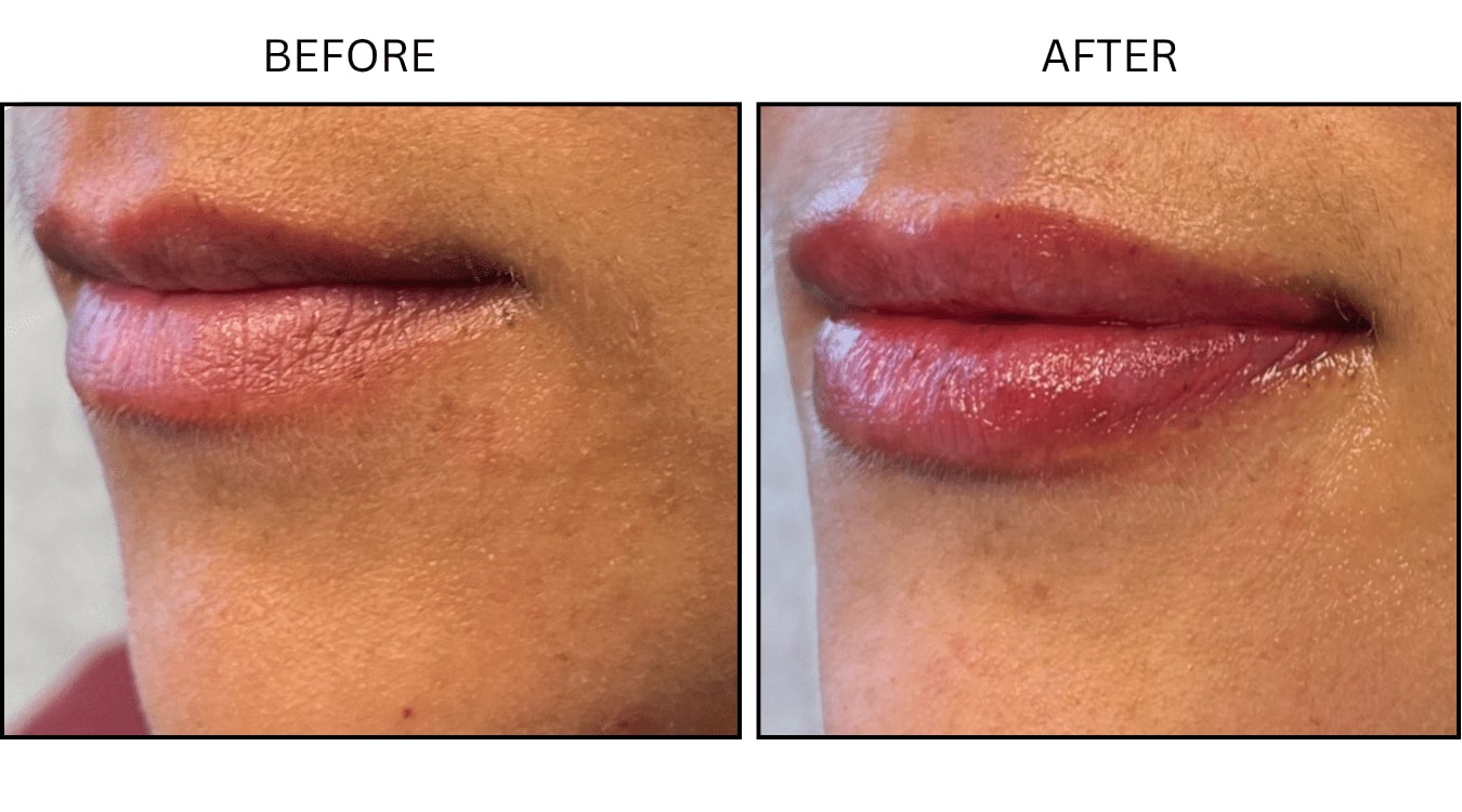 Lips (Fillers), before and after photograph 24