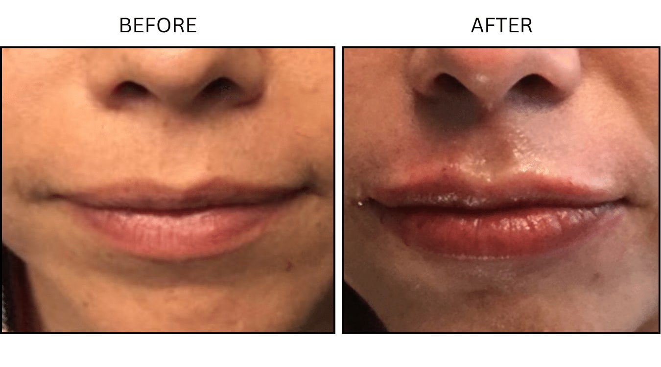 Lips (Fillers), before and after photograph 21