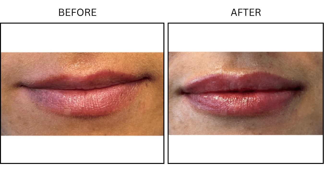 Lips (Fillers), before and after photograph 23