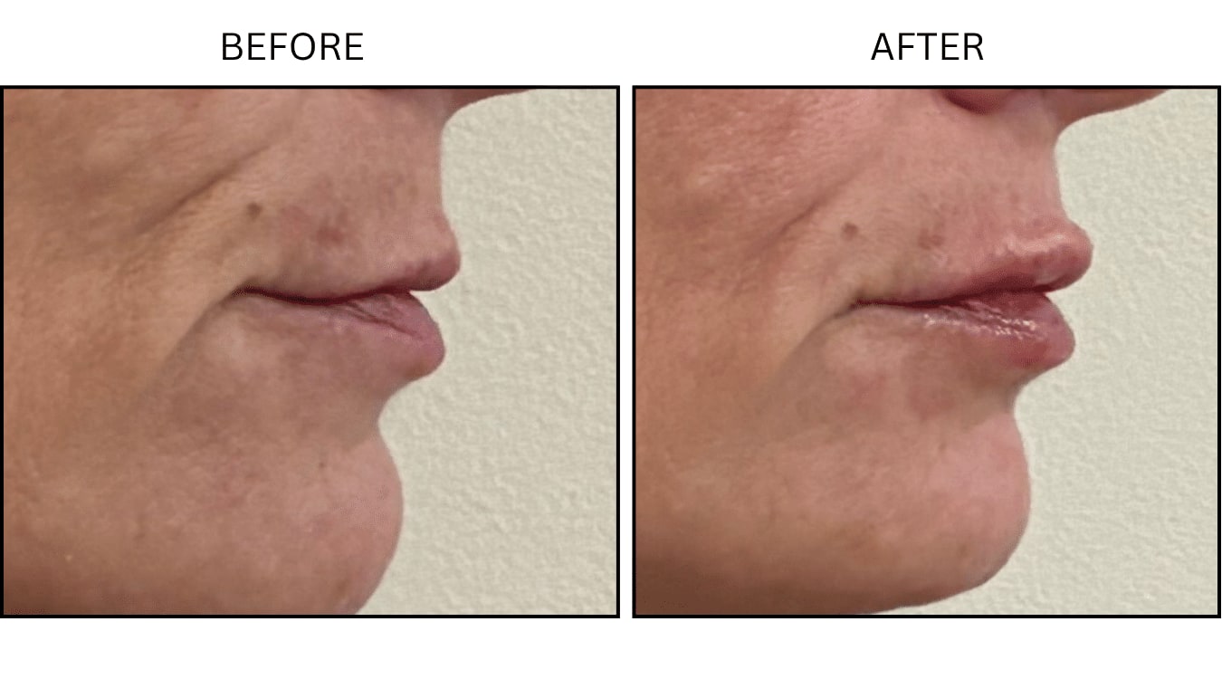 Lips (Fillers), before and after photograph 20