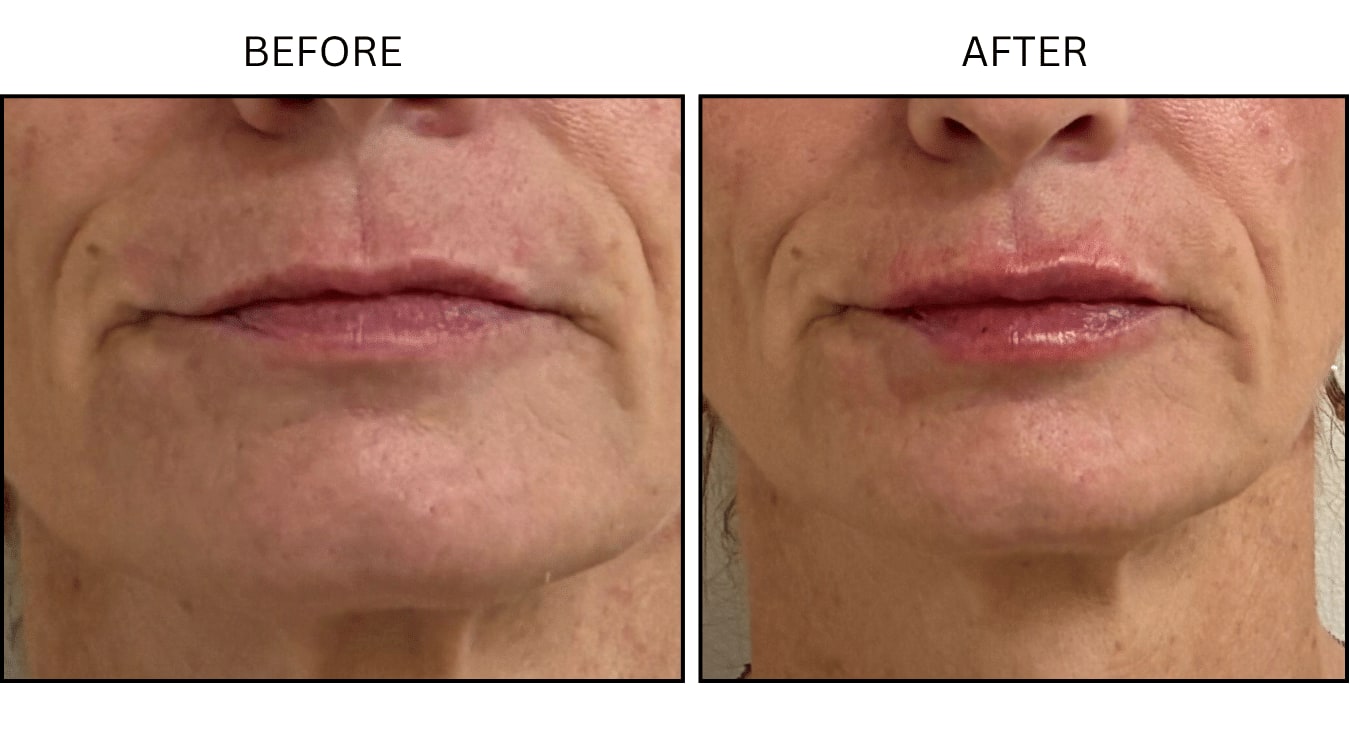 Lips (Fillers), before and after photograph 22