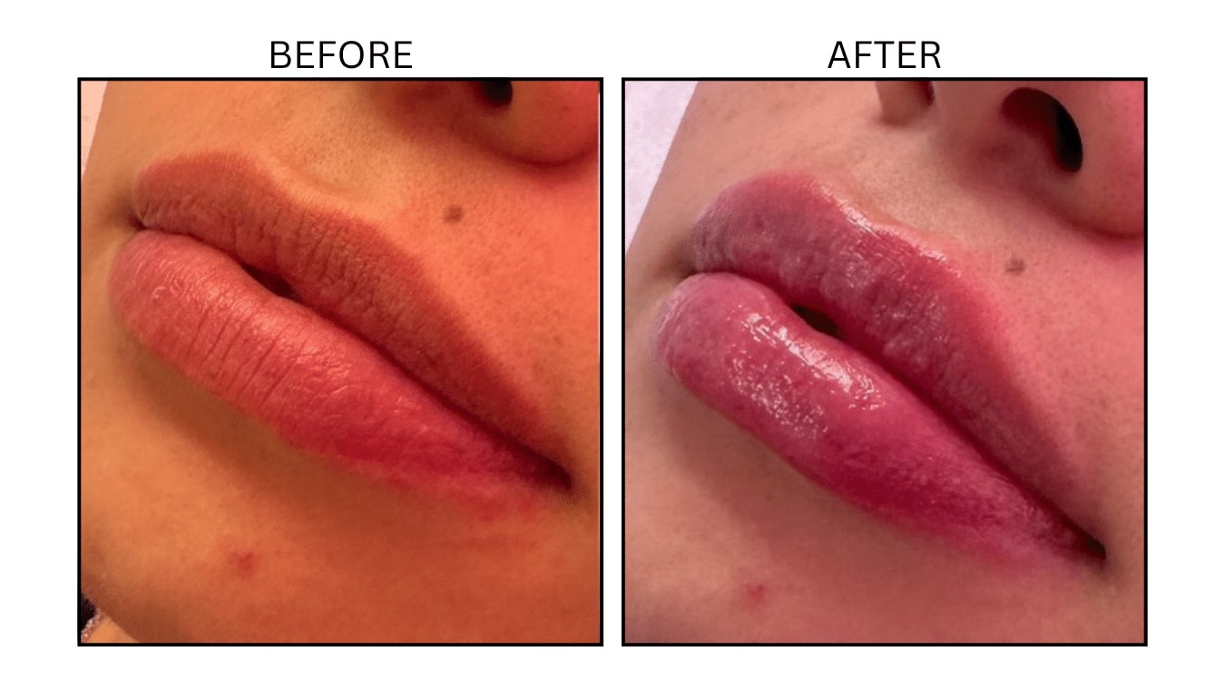 Lips (Fillers), before and after photograph 25