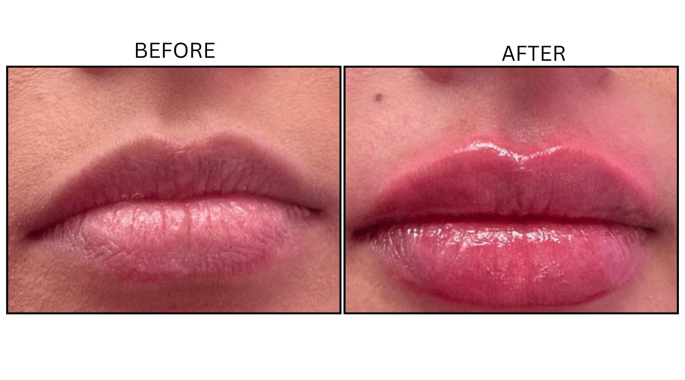 Lips (Fillers), before and after photograph 26