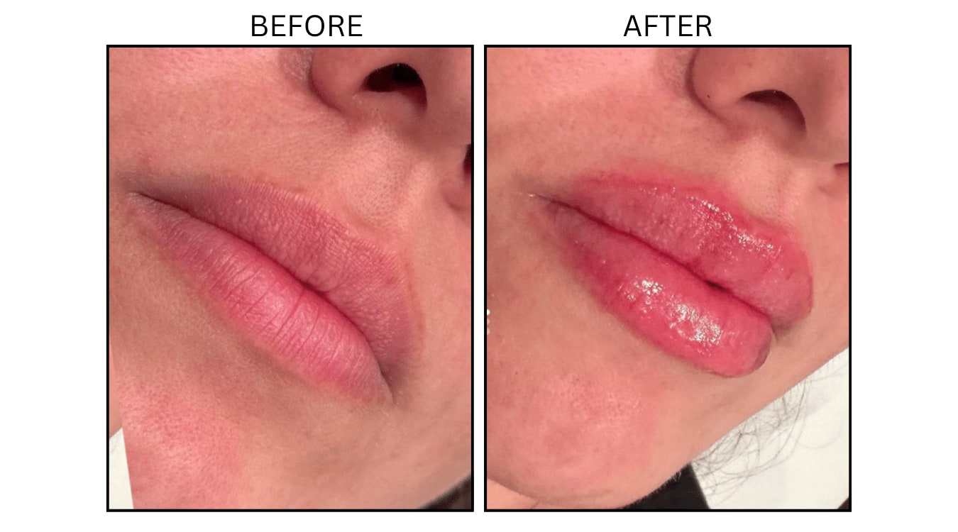 Lips (Fillers), before and after photograph 27