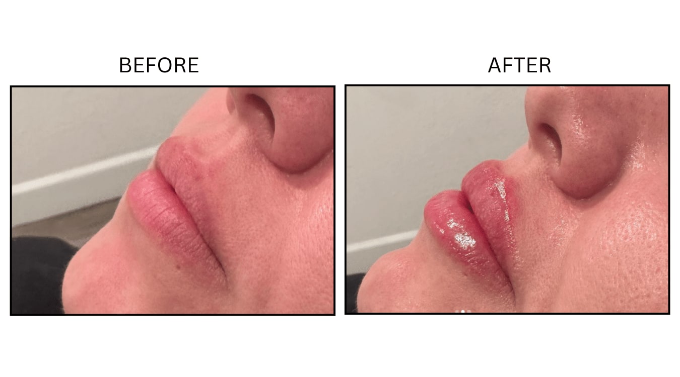 Lips (Fillers), before and after photograph 28
