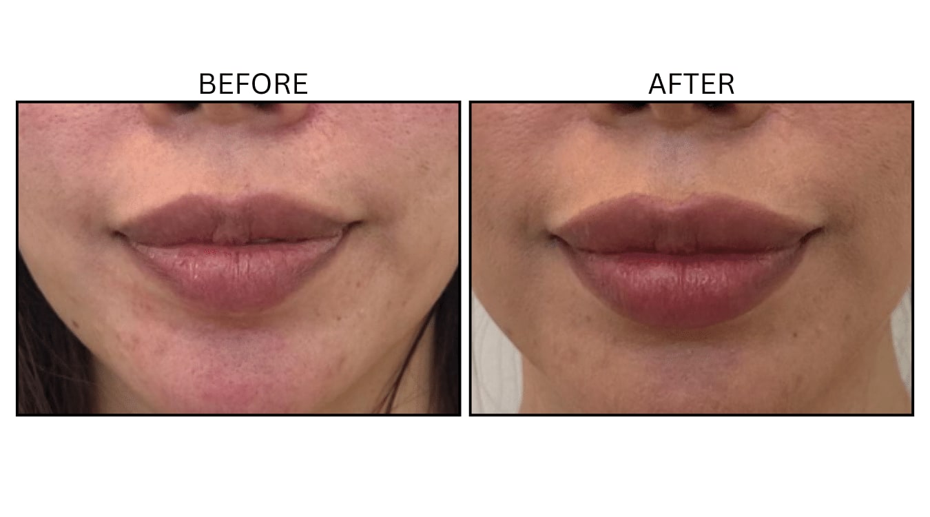Lips (Fillers), before and after photograph 29