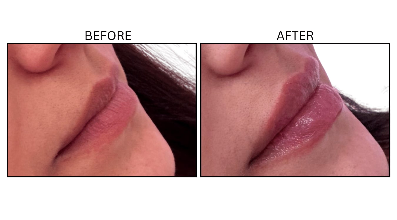 Lips (Fillers), before and after photograph 30
