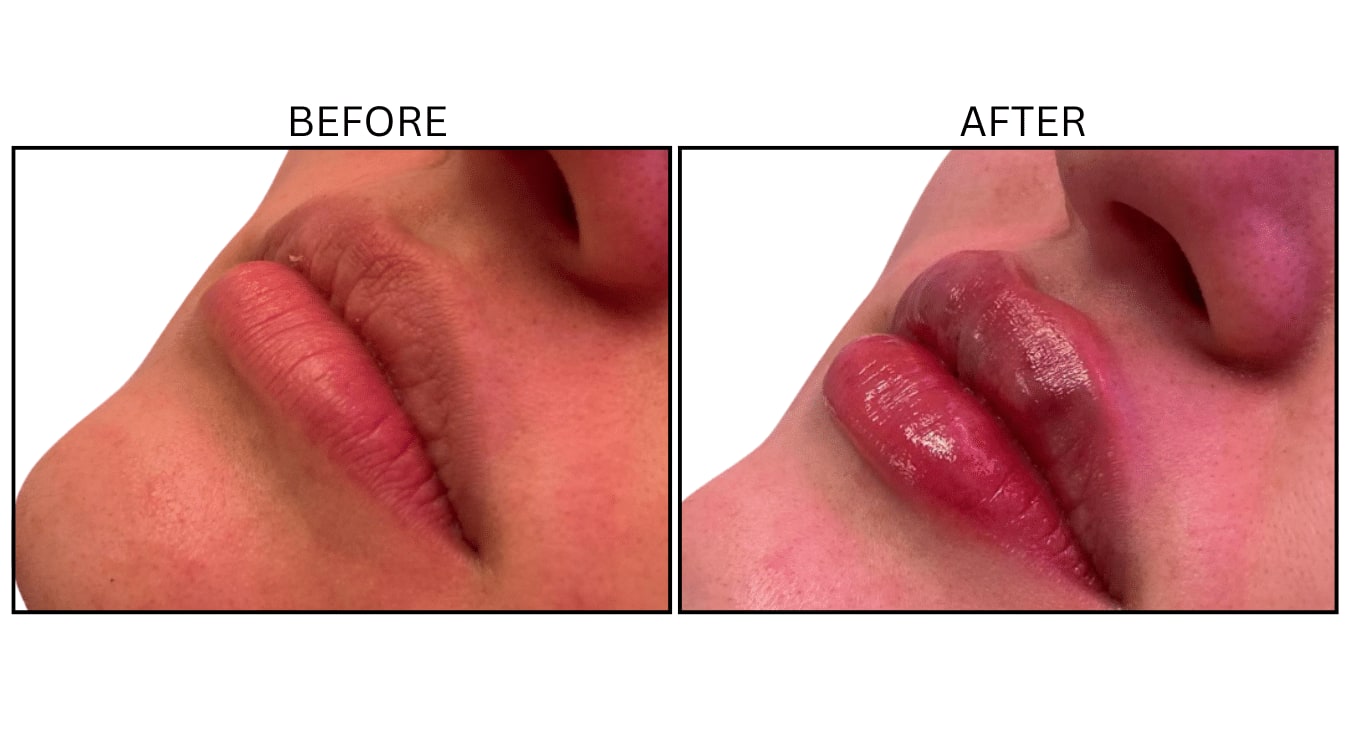 Lips (Fillers), before and after photograph 31