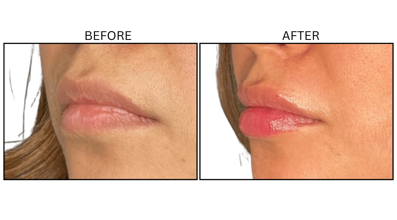 Lips (Fillers), before and after photograph 32
