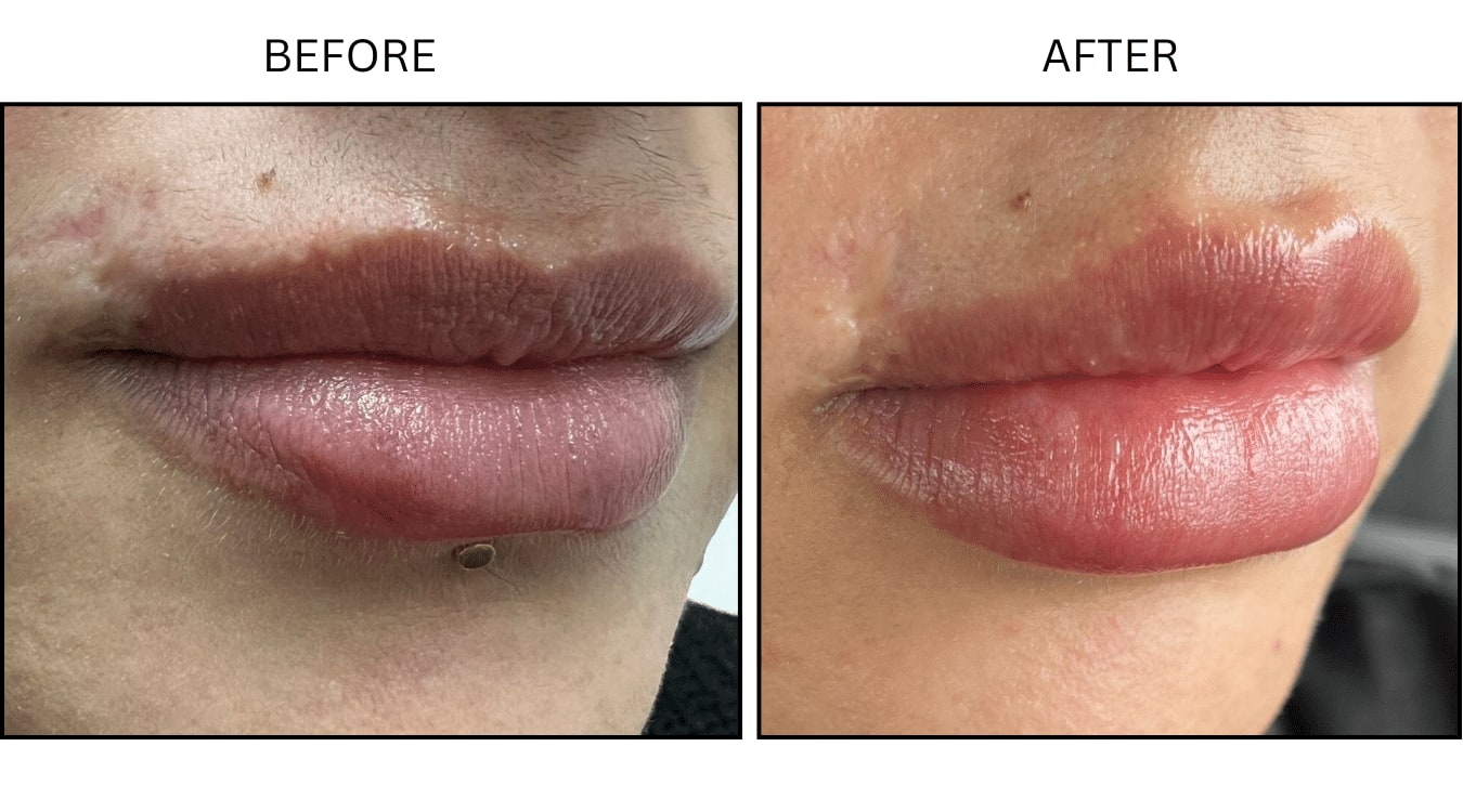 Lips (Fillers), before and after photograph 19
