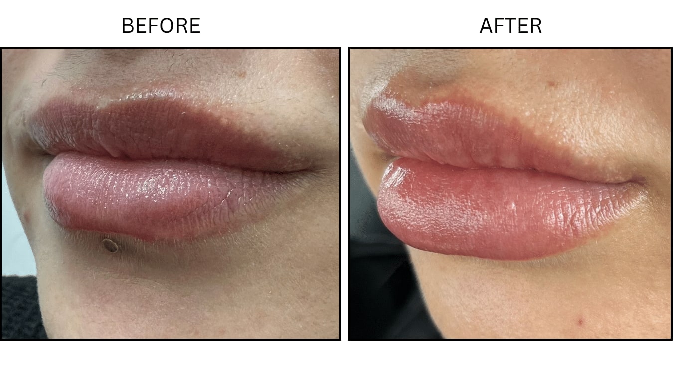 Lips (Fillers), before and after photograph 6
