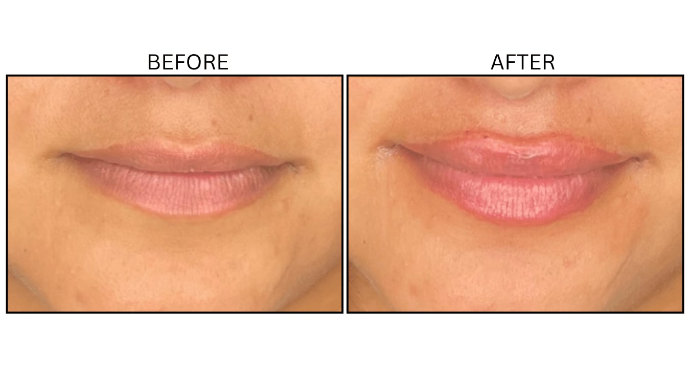 Lips (Fillers), before and after photograph 33
