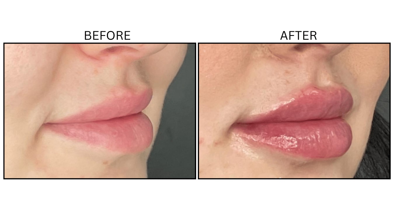 Lips (Fillers), before and after photograph 34