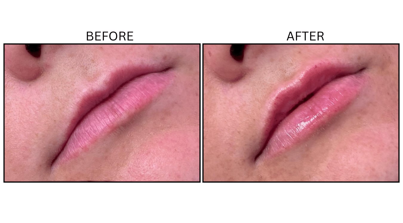 Lips (Fillers), before and after photograph 35