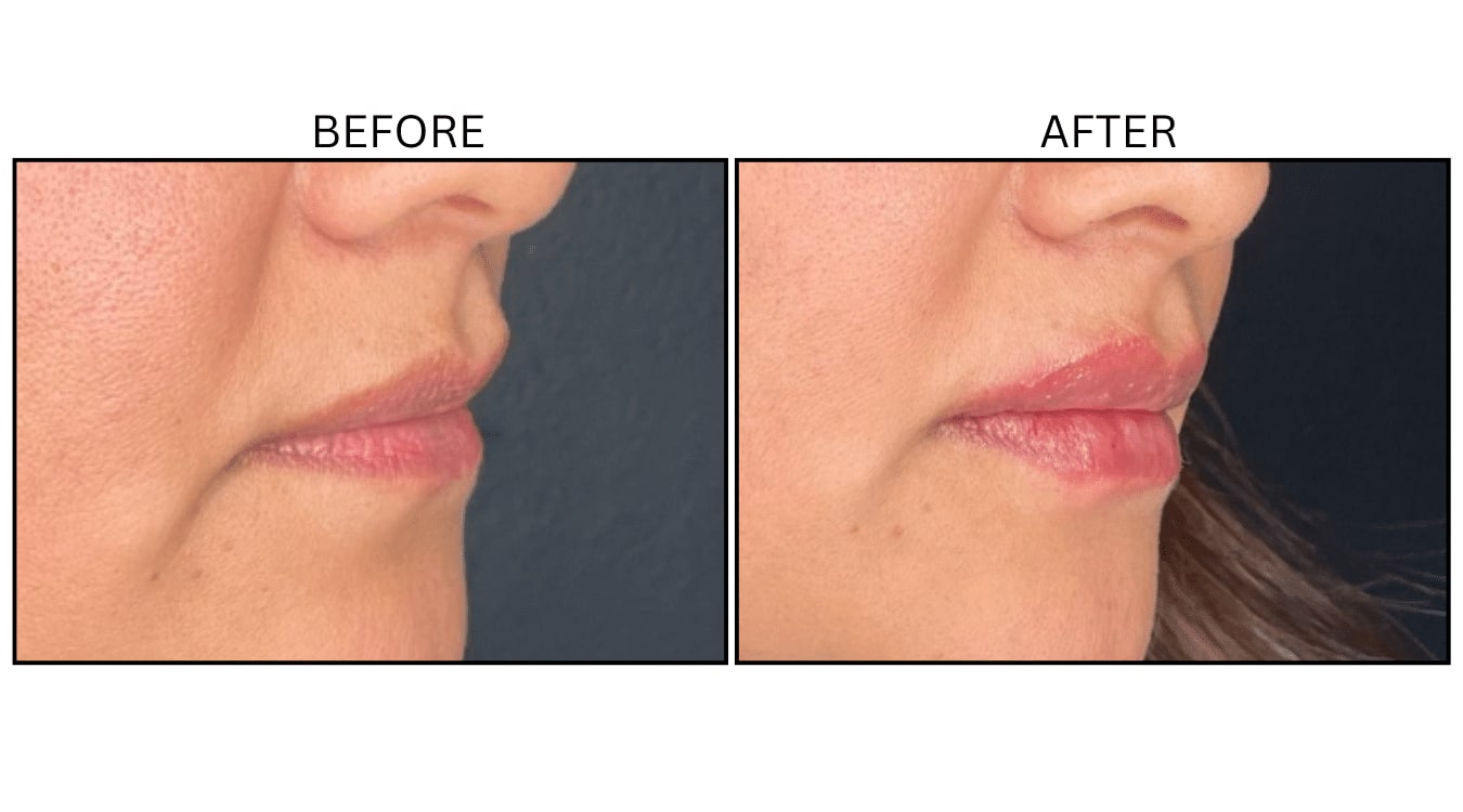 Lips (Fillers), before and after photograph 36