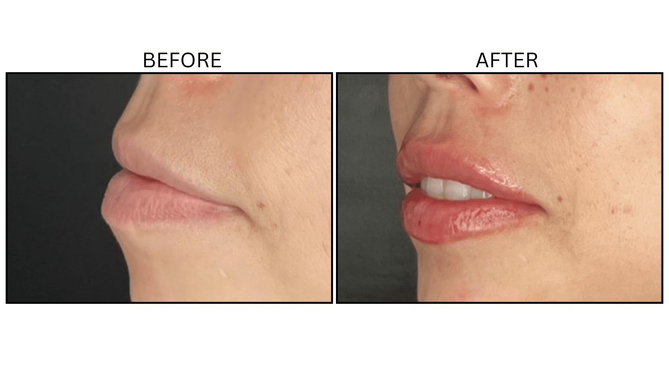 Lips (Fillers), before and after photograph 37