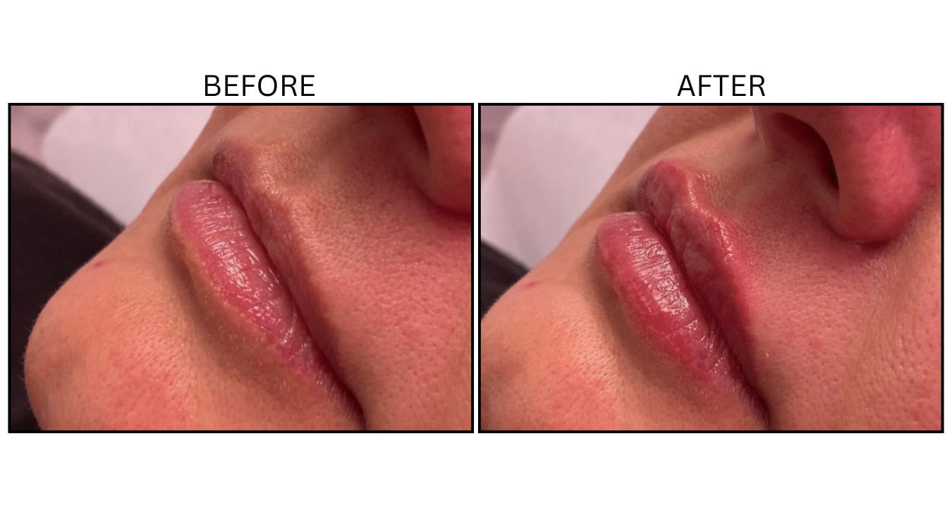 Lips (Fillers), before and after photograph 38