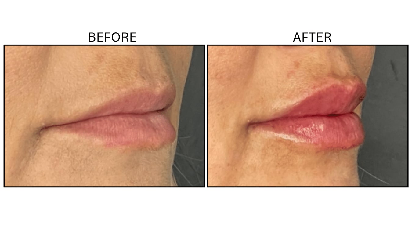 Lips (Fillers), before and after photograph 39