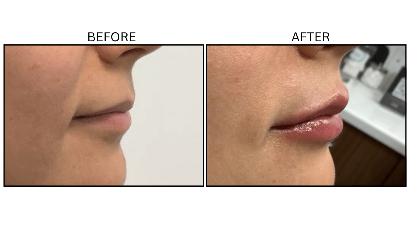 Lips (Fillers), before and after photograph 40