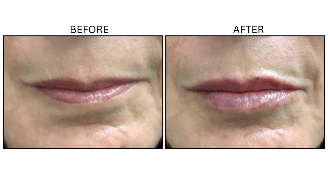 Lips (Fillers), before and after photograph 41