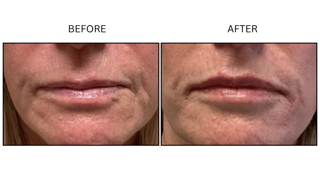 Lips (Fillers), before and after photograph 42