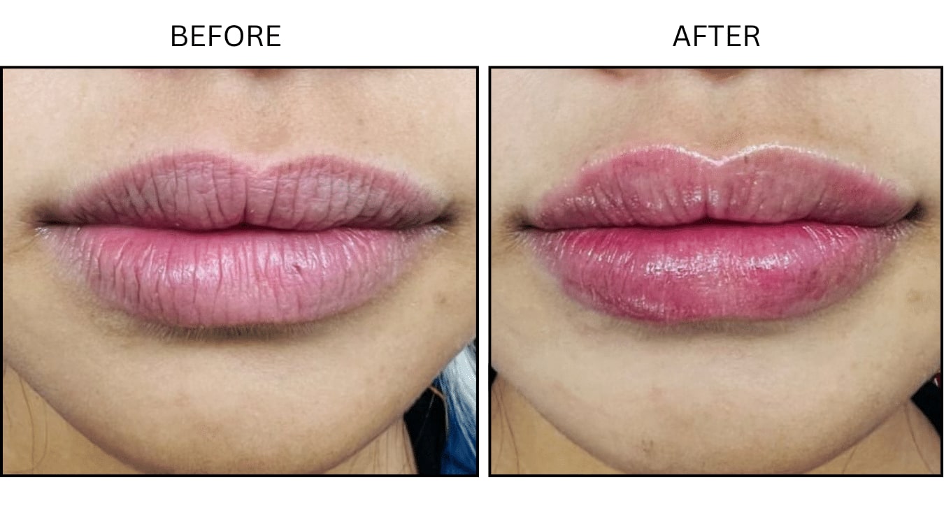Lips (Fillers), before and after photograph 5