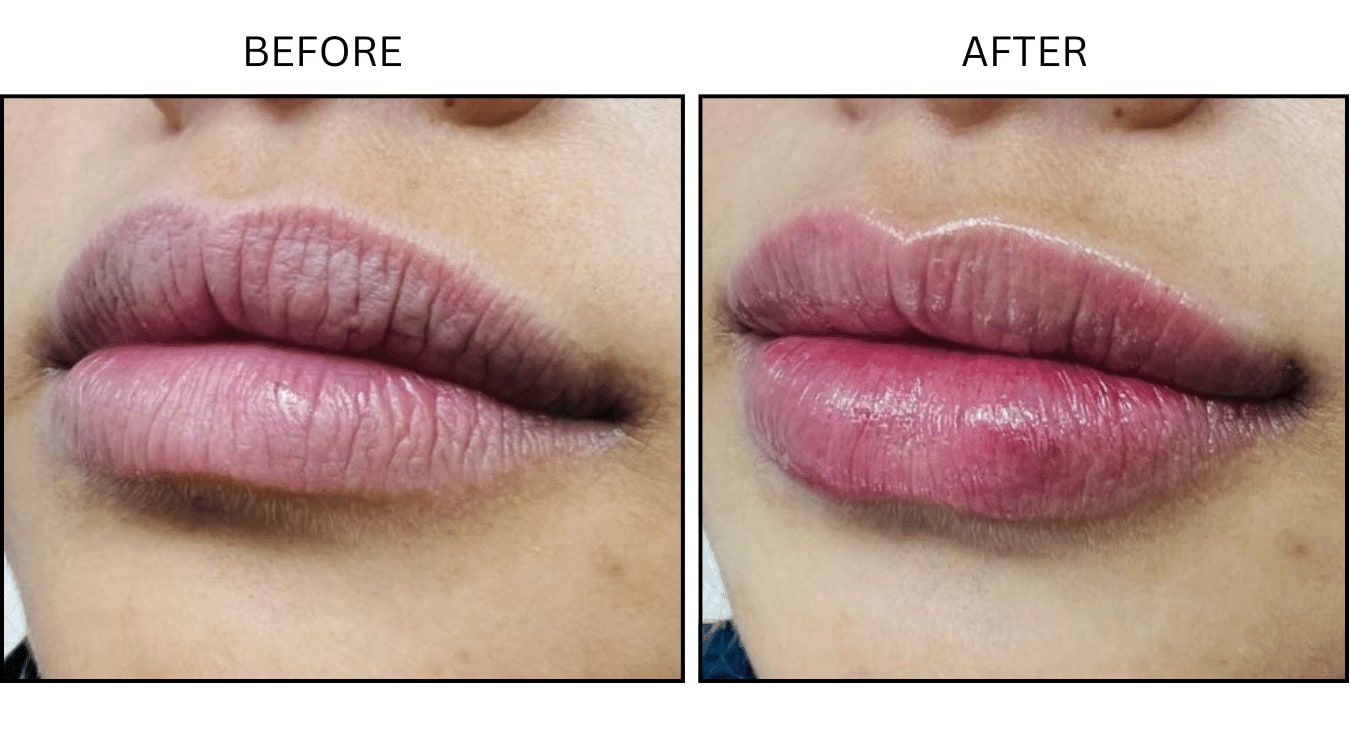Lips (Fillers), before and after photograph 3
