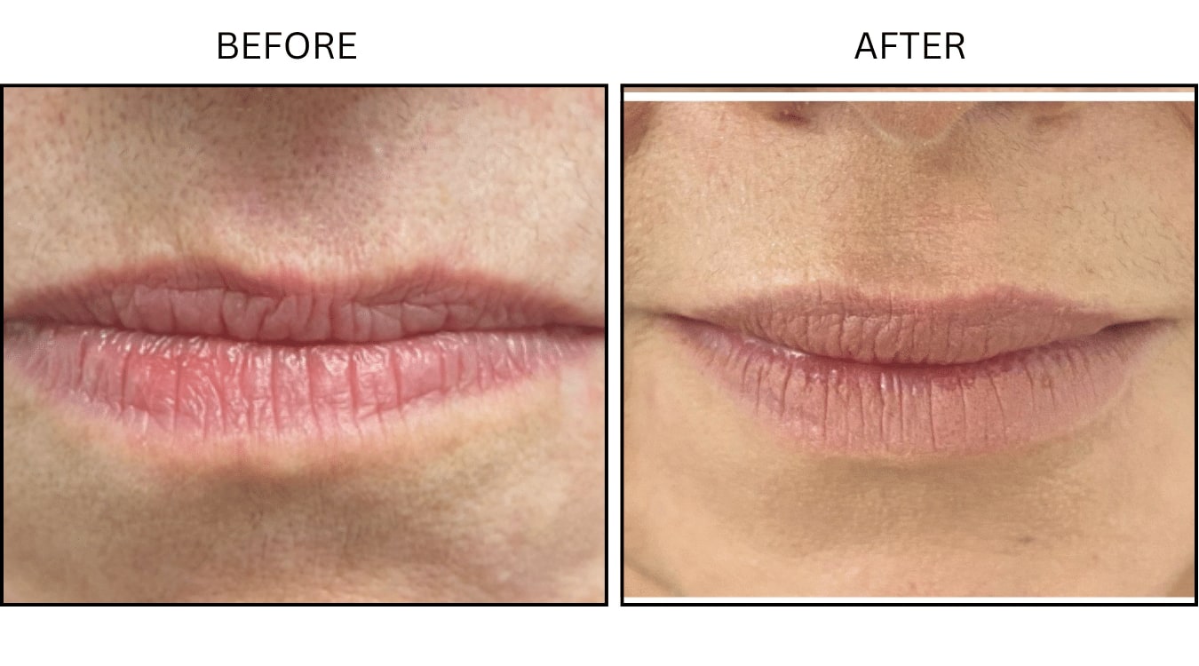 Lips (Fillers), before and after photograph 4