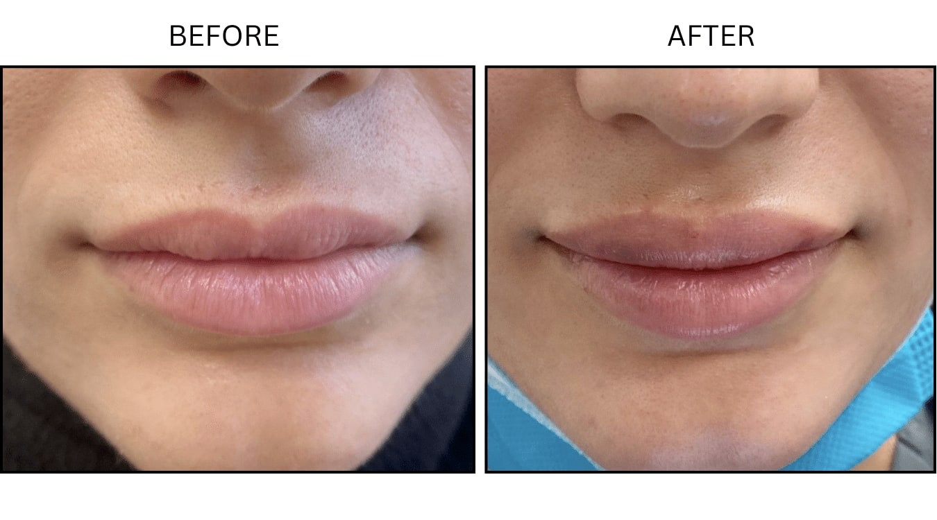 Lips (Fillers), before and after photograph 1