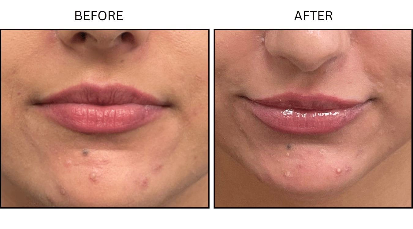 Lips (Fillers), before and after photograph 2
