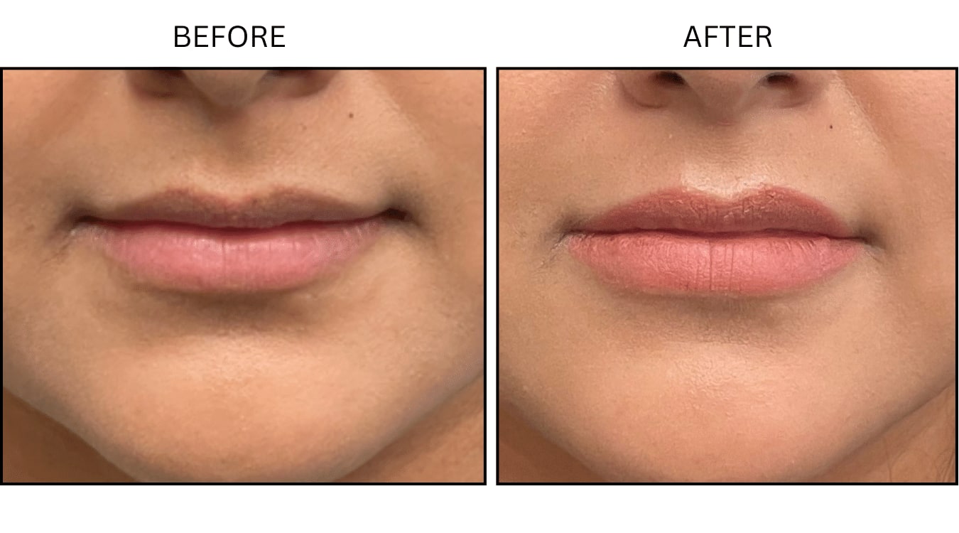 Lips (Fillers), before and after photograph 8