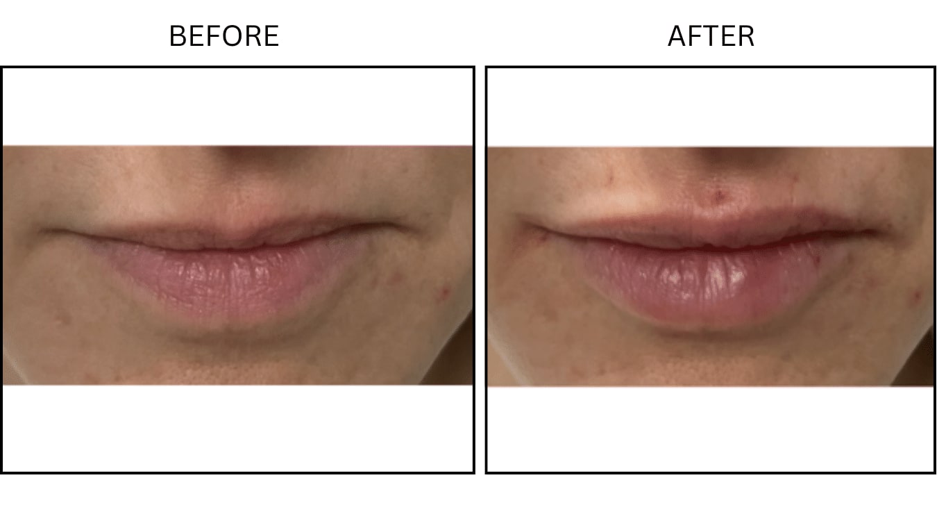 Lips (Fillers), before and after photograph 7