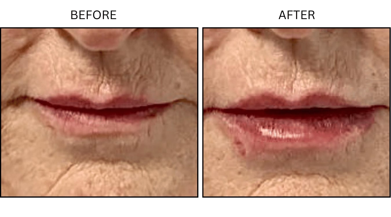 Lips (Fillers), before and after photograph 12