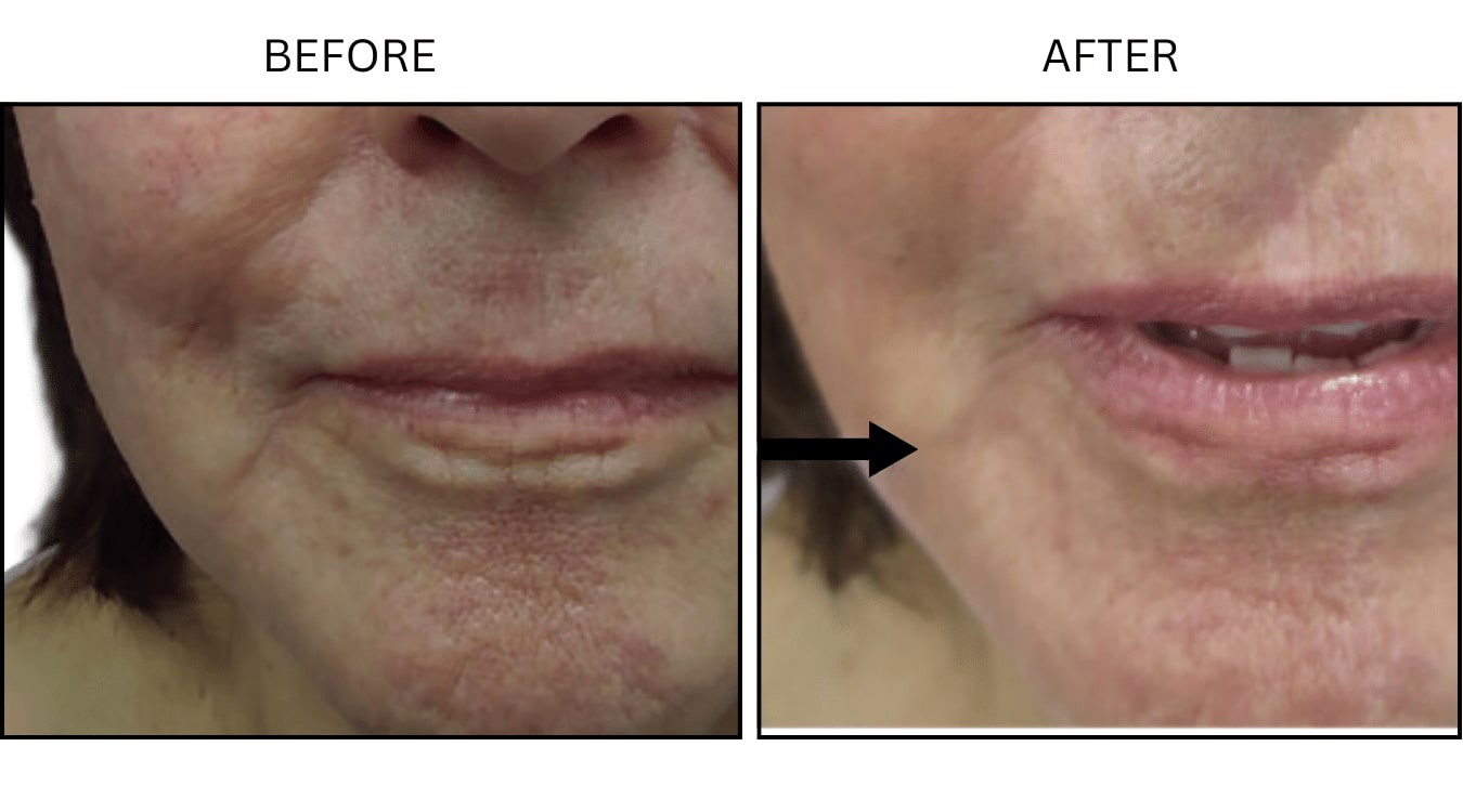 Marionette Lines (Fillers), before and after photograph 1