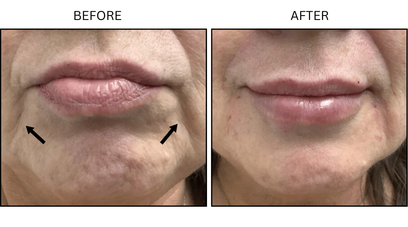 Marionette Lines (Fillers), before and after photograph 2