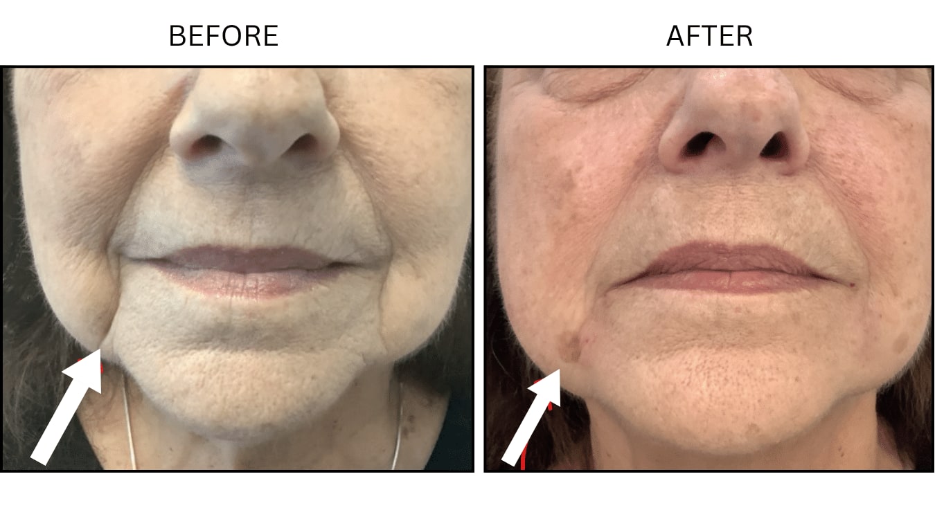 Marionette Lines (Fillers), before and after photograph 4