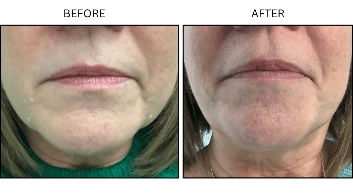 Marionette Lines (Fillers), before and after photograph 3