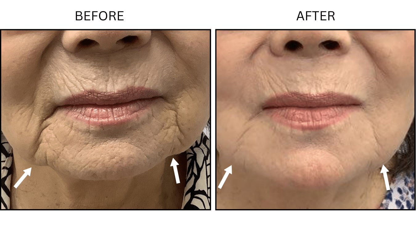 Marionette Lines (Fillers), before and after photograph 5